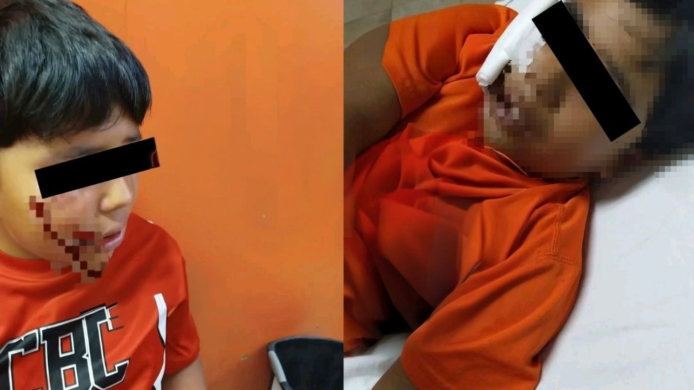 Ataque de perro deja a menor con herida en el rostro, en Huiloapan